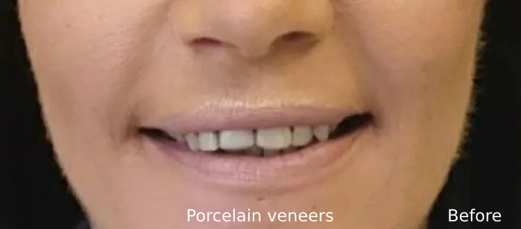 second veneer case before 