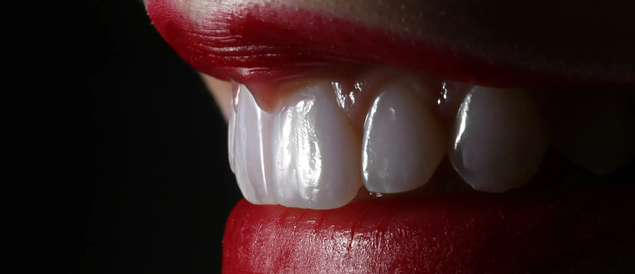 Veneers consultation with cosmetic dentist